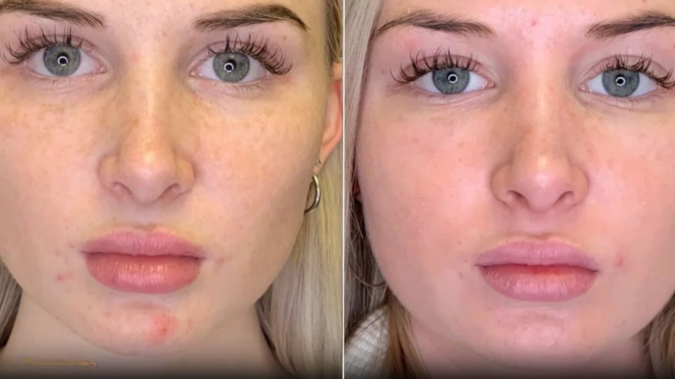 before and after facial images of a blonde woman after a vampire facial was done. Where in the after photo her skin noticeably has less blemishes.